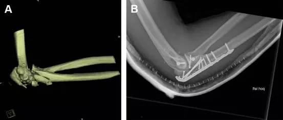 成人脱臼接骨视频讲解教程,轻松掌握骨折复位技巧