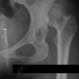 成人脱臼接骨视频讲解教程,轻松掌握骨折复位技巧