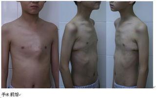 成人女性鸡胸治疗方法视频,成人女性鸡胸治疗视频攻略
