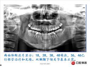 成人正畸拔牙真人图片视频,真人案例图片视频深度解析